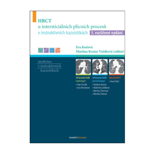 HRCT u intersticiálních plicních procesů v instruktivních kazuistikách