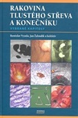 Rakovina tlustého střeva a konečníku