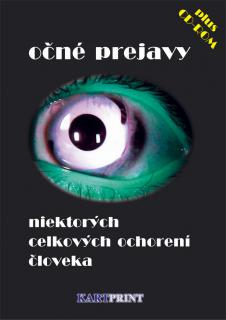 Očné prejavy niektorých celkových ochorení človeka + CD